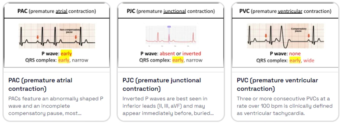 Three cards on the Internal Medicine board: PAC, PJC and PVC, each with the rhythm strip from Phoebe's guide
